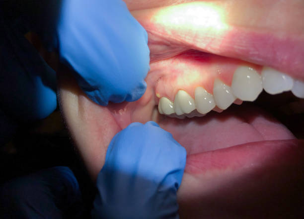 Best Emergency Root Canal Treatment in Aust, IN